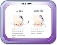 Resultados Antes y después del tratamiento Emsella Resultados Antes y después del tratamiento Emsella