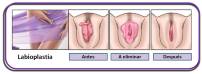 Resultados Antes y Despúes de una labioplastia Resultados Antes y Despúes de una labioplastia