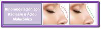 Rinomodelación Rinomodelación